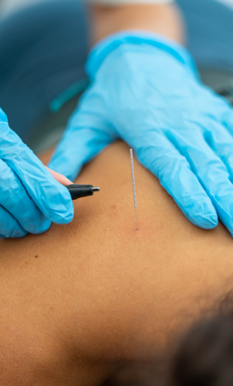 Dry Needling Therapy